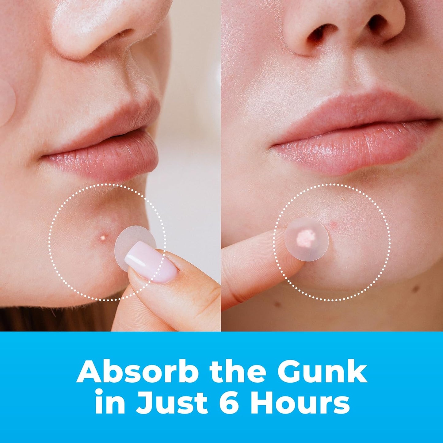 Pimple Patches for Face (240 Patches), Hydrocolloid Acne Patches with Tea Tree Oil, Pimple Patch Pimple Stickers - Hydrocolloid Patch Acne Dots - Acne Pimple Patches for Face - Zit Patches