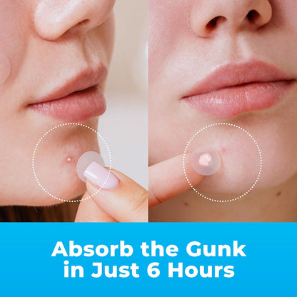 Pimple Patches for Face (240 Patches), Hydrocolloid Acne Patches with Tea Tree Oil, Pimple Patch Pimple Stickers - Hydrocolloid Patch Acne Dots - Acne Pimple Patches for Face - Zit Patches